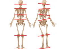 Beinlängendifferenz - Was steckt dahinter?